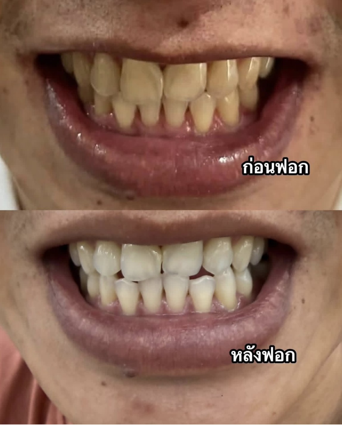 การดูแลช่องปากด้วยความนุ่มนวล